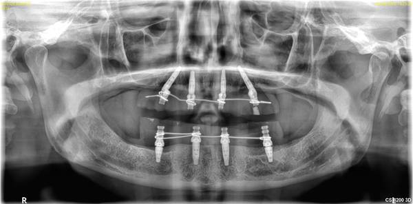 AO4 Xray