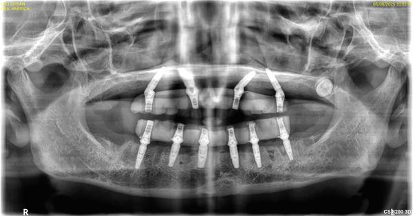 PAT Xray