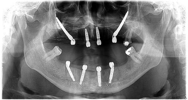 Zygomatic Xray